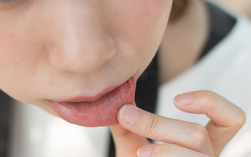 口内炎は薬で治らない？ 特徴や原因を知って正確に対応しよう