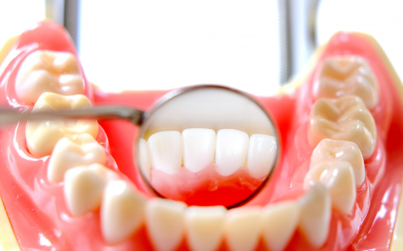 歯肉炎とは？ 症状・原因・対策と要治療の危険な歯肉炎を紹介