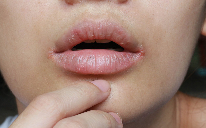 口角炎はカンジダ（カビ）菌が原因！ 症状・治療法・予防法は？