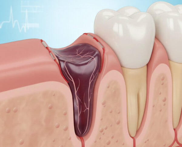 血餅のイラスト
