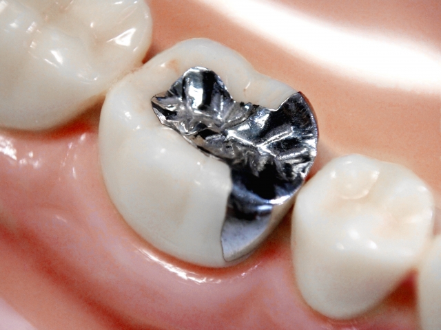 銀歯はしみることがある？ 銀歯がしみる原因と対処法