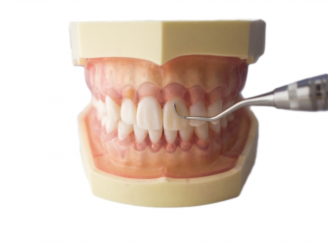 歯石除去時に痛みがある理由とは？ 痛みへの予防策とセルフケア方法を紹介