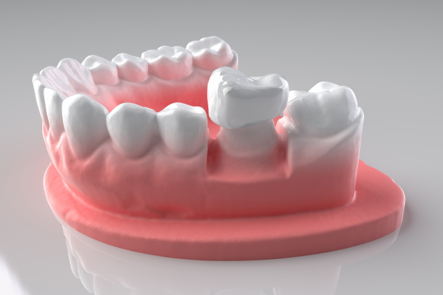 奥歯の抜歯後そのままにしておく9つのリスクと対処法とは？