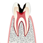 C3：神経のむし歯